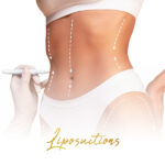 liposuction